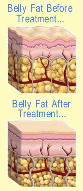 Belly Fat Treatment